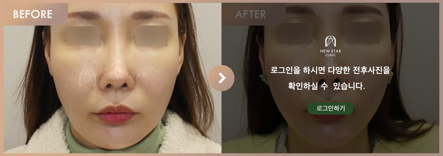 Before & After
