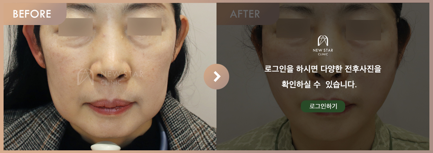 Before & After