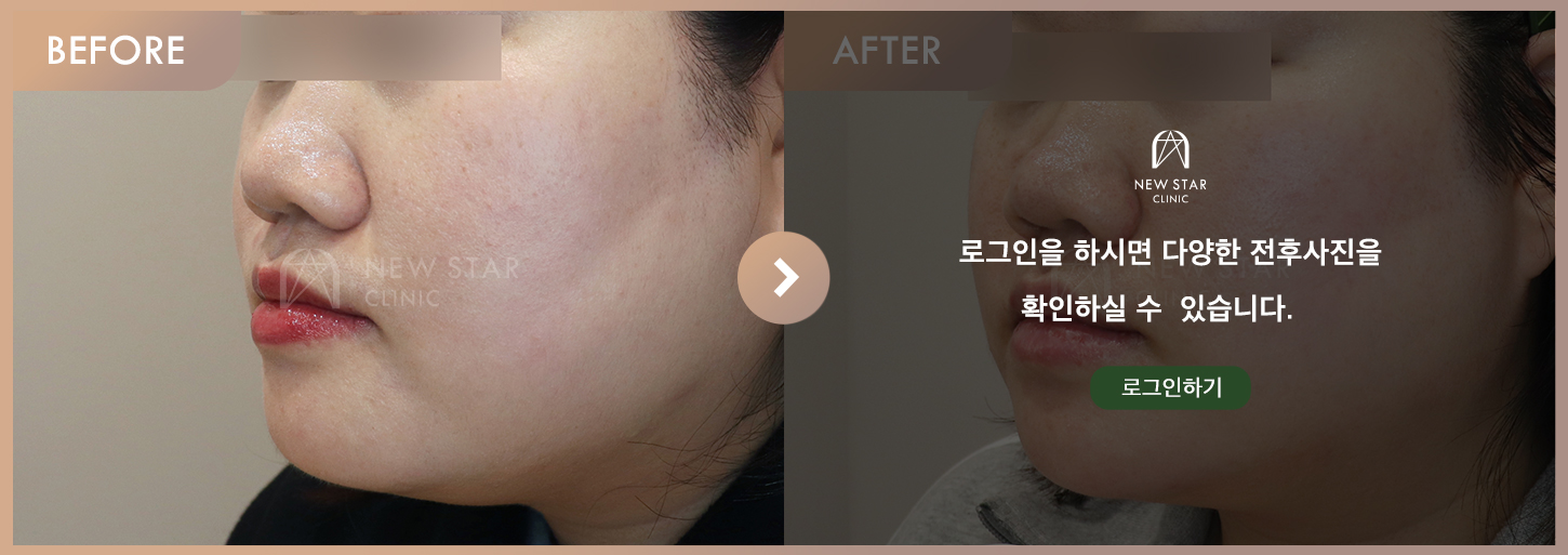 Before & After