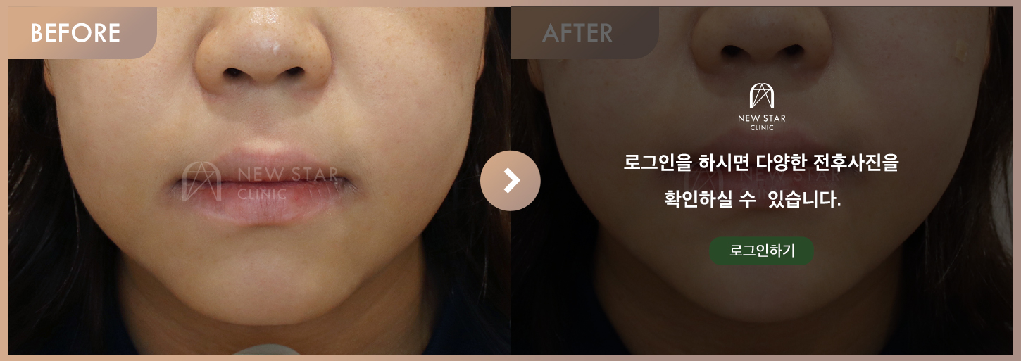 Before & After