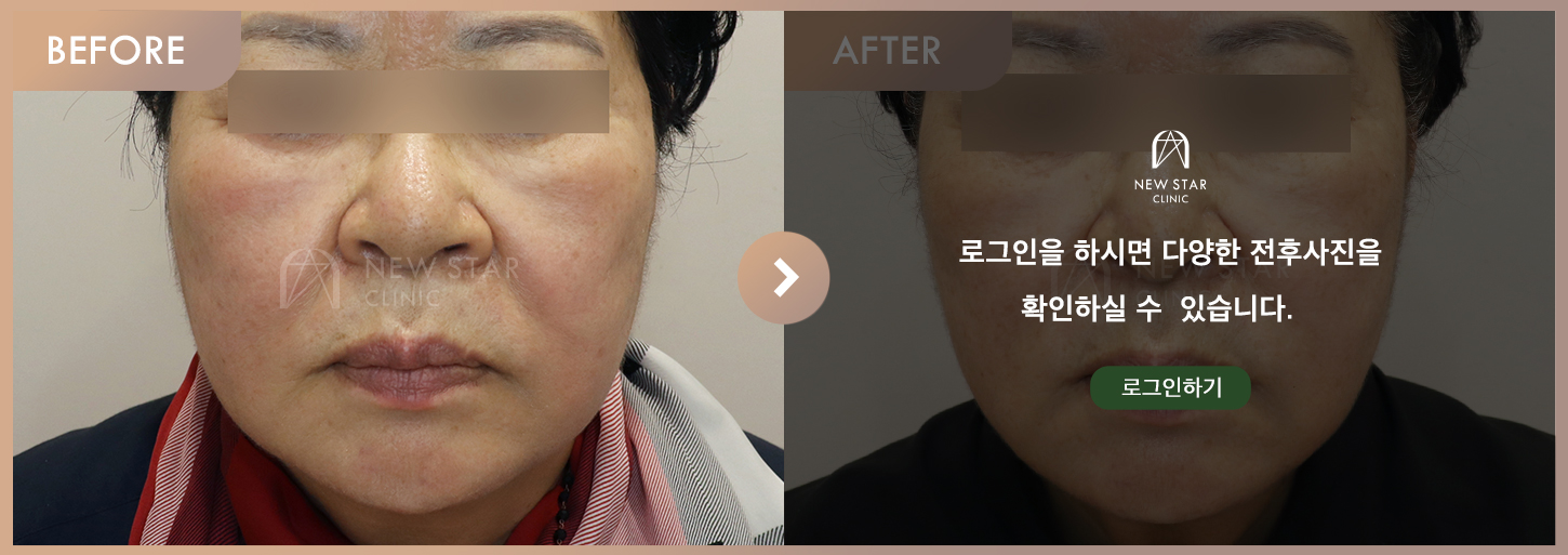 전후사진