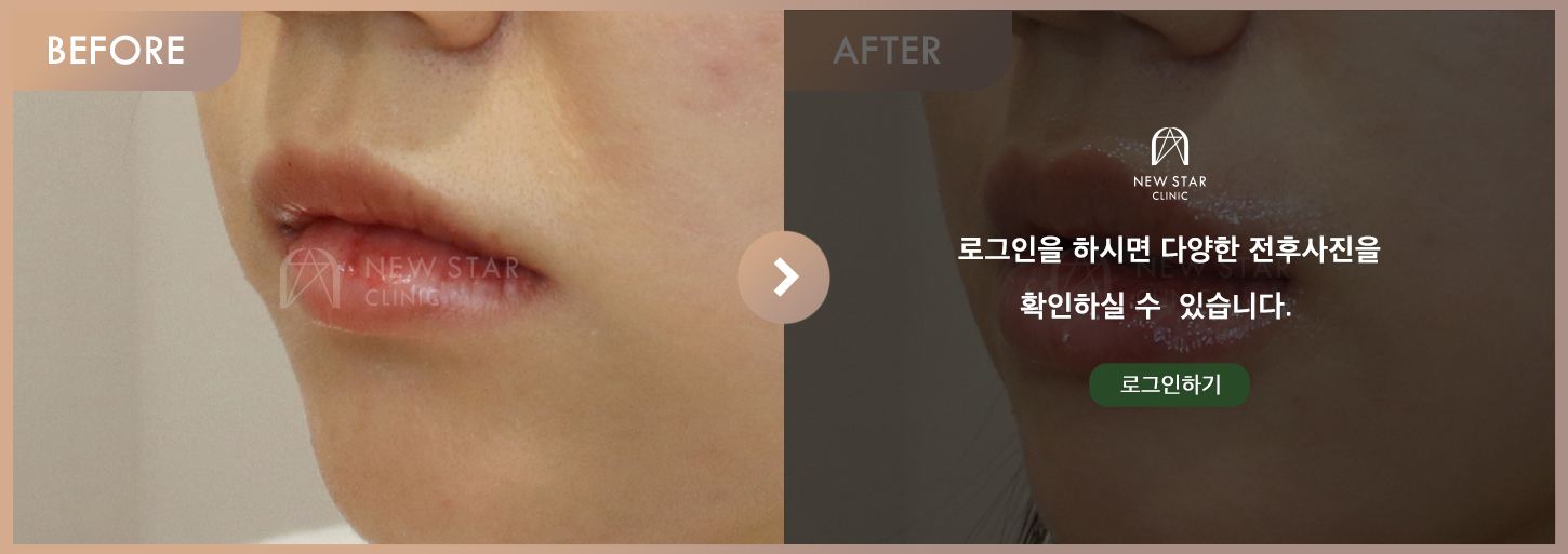 전후사진