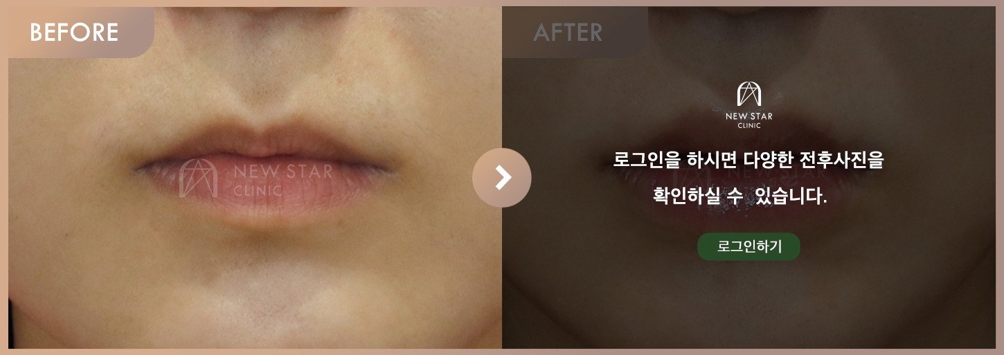 전후사진