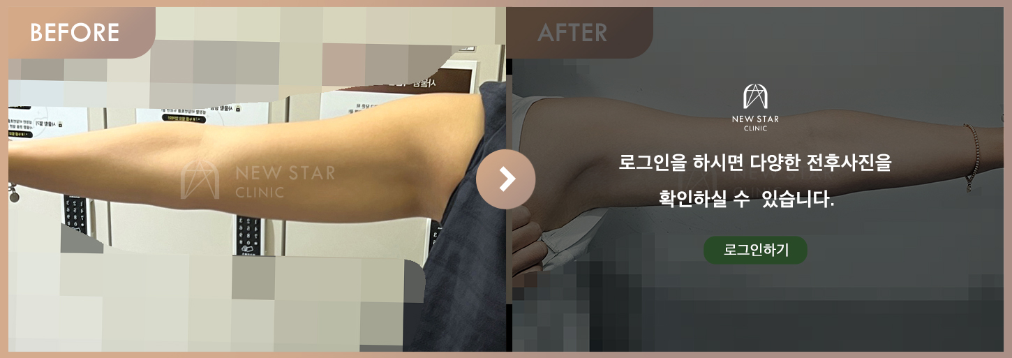 전후사진
