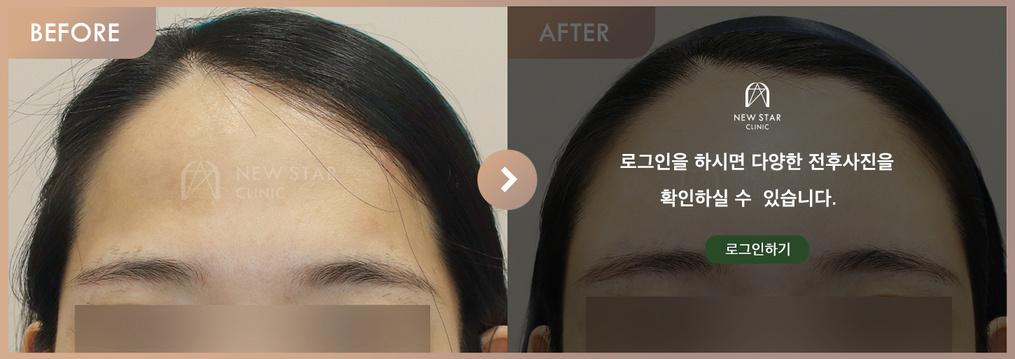 전후사진
