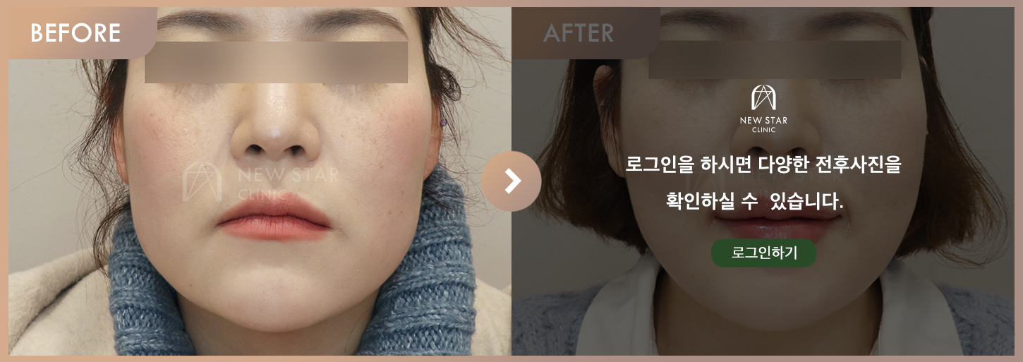 전후사진