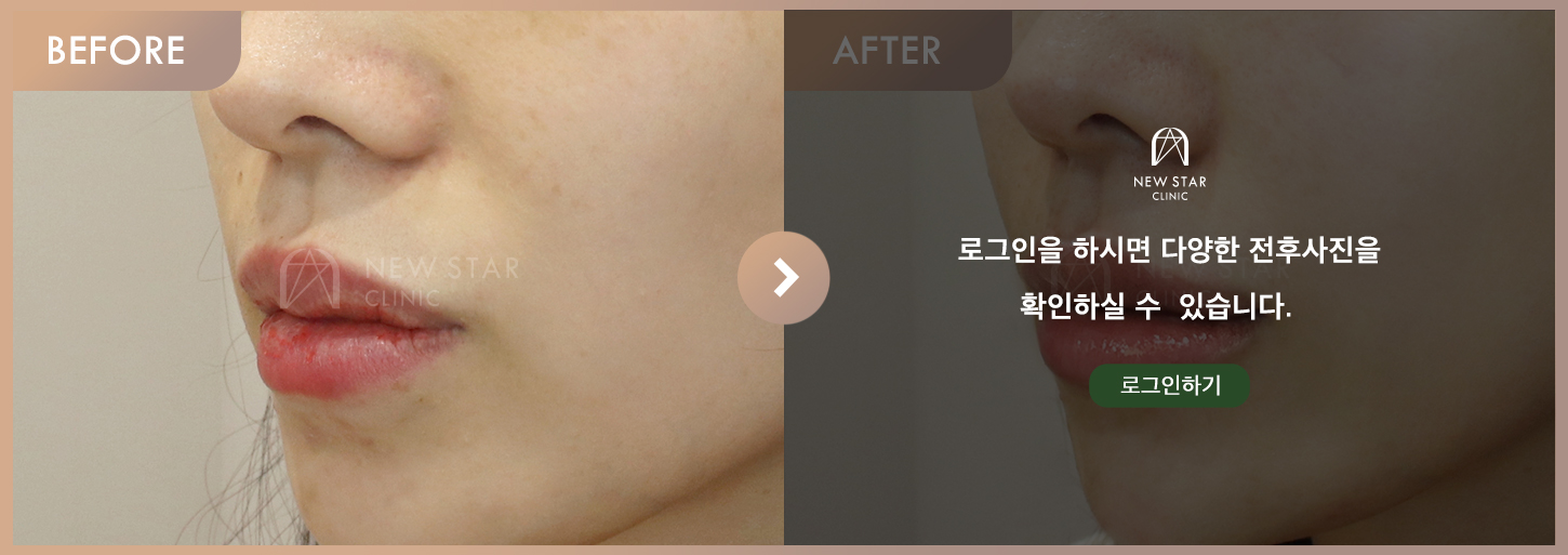 전후사진