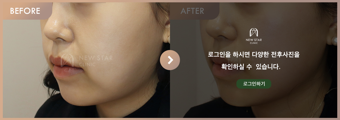 전후사진